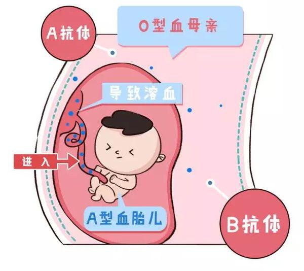 abo溶血在孩子出生的时候才出现吗